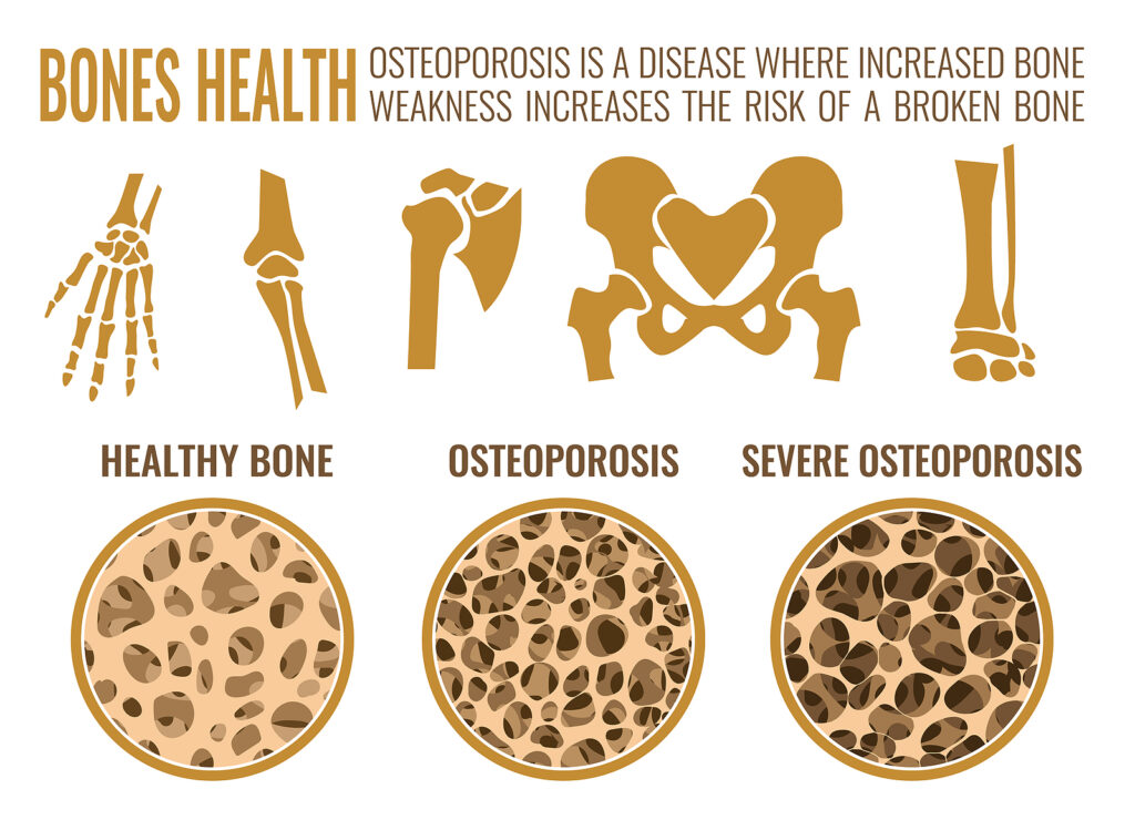 Osteoporosis stages image. 